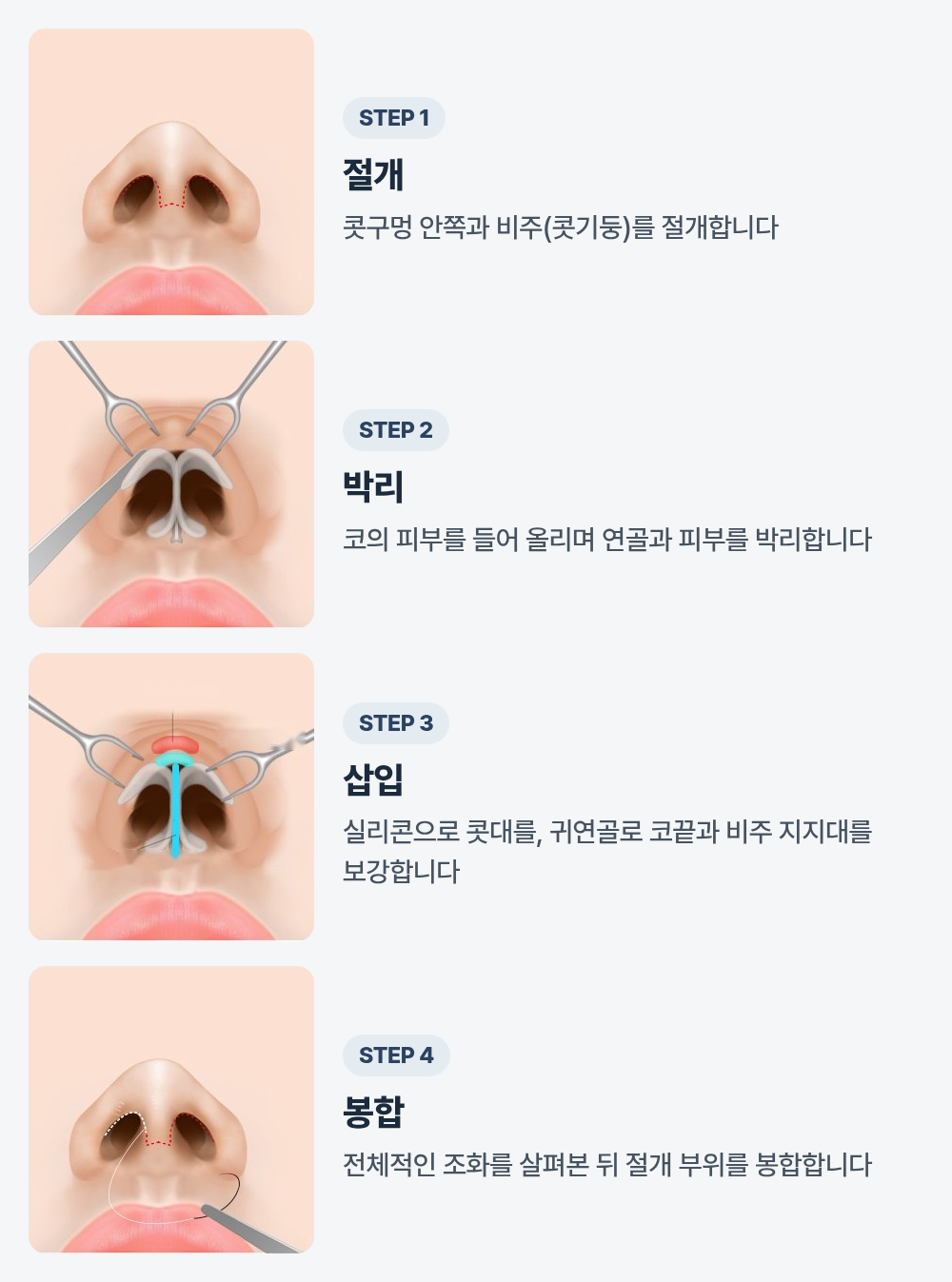 코를 아래에서 본 일러스트 네 장. 1단계는 콧기둥과 콧구멍 안쪽의 절개선, 2단계는 기구로 피부를 들어 올려 코끝 연골이 드러난 모습, 3단계는 실리콘으로 콧대를, 귀연골로 코끝과 콧기둥 지지대를 보강하는 모습, 4단계는 절개 부위를 봉합하는 모습입니다.
