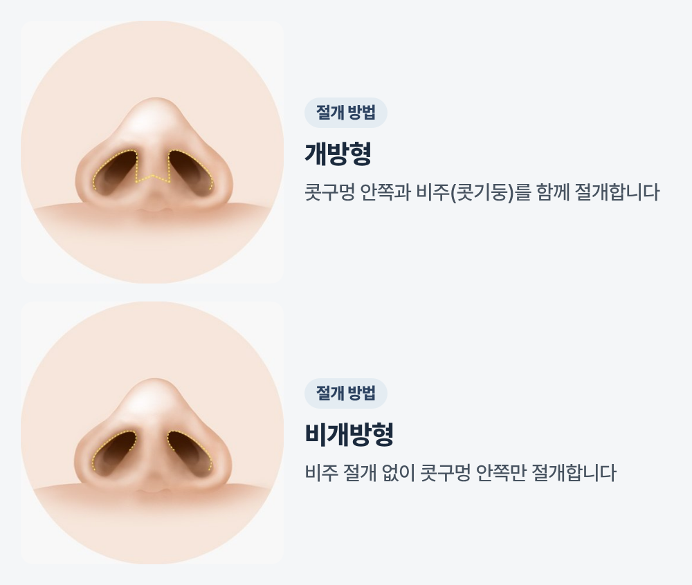 코를 아래에서 올려다본 일러스트 두 장. 첫째는 콧구멍 안쪽과 콧기둥(비주)을 가로지르는 절개선이 점선으로 표시된 개방형, 둘째는 콧기둥 절개 없이 콧구멍 안쪽에만 절개선이 표시된 비개방형입니다.