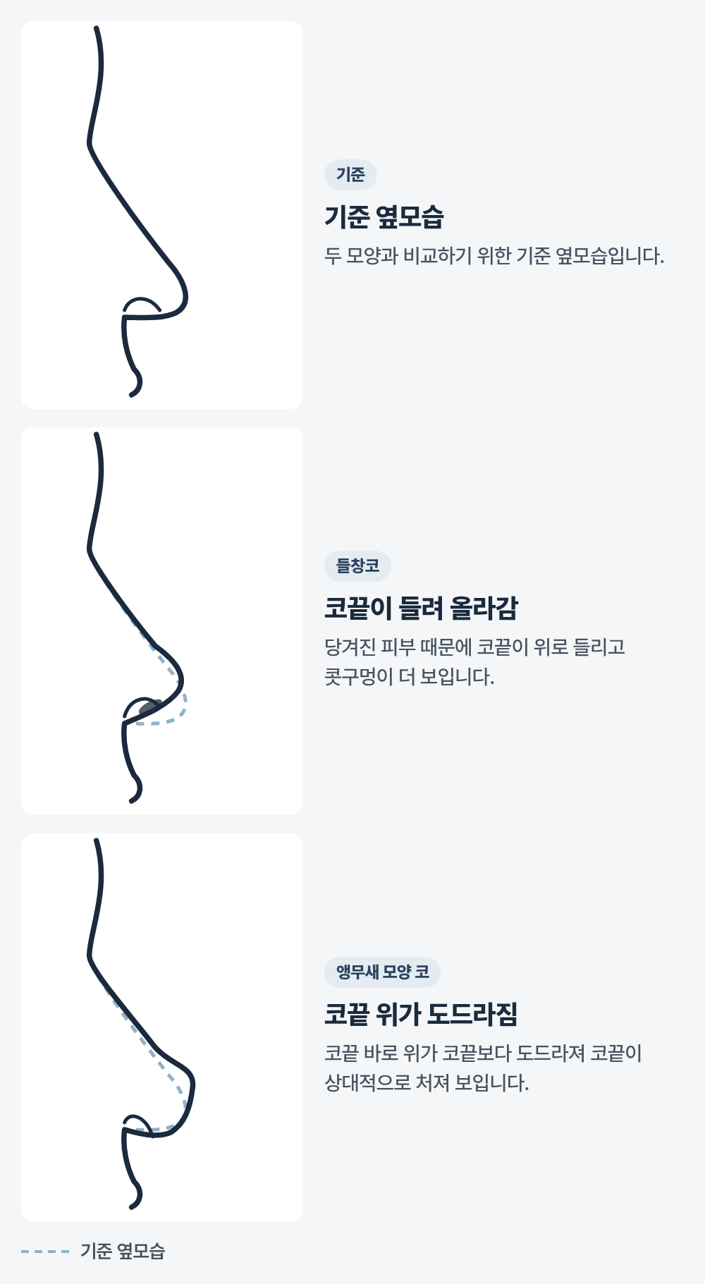코 옆모습 선화 세 장. 첫째는 기준 옆모습, 둘째는 옅은 점선으로 그린 기준보다 코끝이 위로 들려 콧구멍이 보이는 들창코 모양, 셋째는 코끝 바로 위가 코끝보다 도드라져 코끝이 상대적으로 처져 보이는 앵무새 부리 모양입니다.