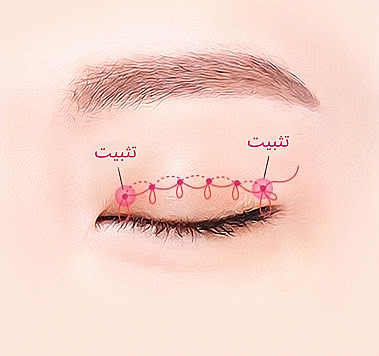 رسم تخطيطي يوضح مبدأ جراحة الجفن المزدوج غير الجراحية بربط الخيط عبر عقد متتالية على طول خط الجفن المغلق وتثبيت الطرفين