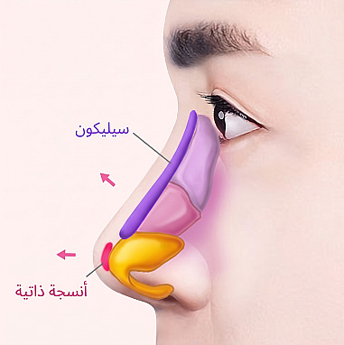 رسم جانبي يوضح إدخال حشوة السيليكون في جسر الأنف واستخدام الأنسجة الذاتية في أرنبة الأنف أثناء تجميل الأنف للرجال