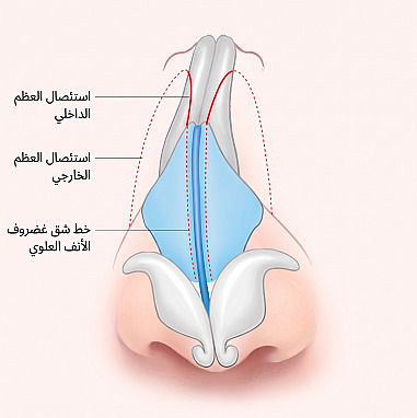 رسم توضيحي للبنية الداخلية للأنف يوضح مواضع قص العظم الداخلي والخارجي وخط شق غضروف الأنف العلوي لجراحة تجميل الأنف للرجال