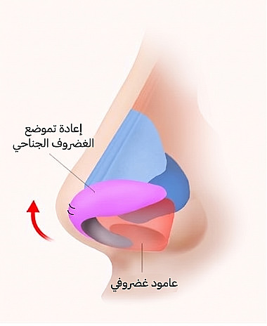 مخطط تشريحي جانبي للأنف يوضح مبدأ رفع أرنبة الأنف عبر إعادة تموضع الغضاريف الجناحية والدعامات الغضروفية أثناء تجميل الأنف الطويل / الأنف المعقوف