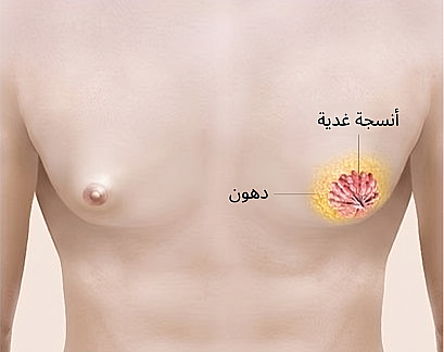 رسم توضيحي طبي يوضح موقع الأنسجة الغدية والدهون لشرح أسباب التثدي في صدر الرجل