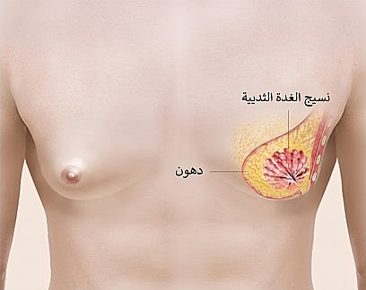 رسم توضيحي يوضح البنية التشريحية للتثدي وموضع الدهون والغدد الثديية داخل صدر الرجل