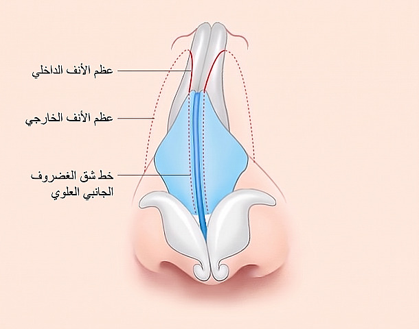 رسم توضيحي لطريقة جراحة تجميل الأنف المائل يوضح خطوط قطع العظم الداخلي والخارجي وشق الغضروف الأنفي العلوي على عظام وغضاريف الأنف