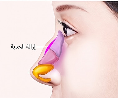 مخطط جانبي يوضح موضع إزالة الحدبة الأنفية من العظام والغضاريف البارزة على جسر الأنف أثناء تجميل الأنف المعقوف