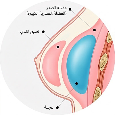 رسم تشريحي لمقطع عرضي للثدي يوضح موضع الحشوة تحت العضلة الصدرية الكبرى أثناء جراحة تكبير الثدي