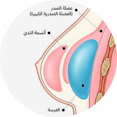 رسم تشريحي مقطعي يوضح موقع الحشوة تحت العضلة الصدرية الكبيرة وأنسجة الثدي أثناء جراحة تكبير الثدي
