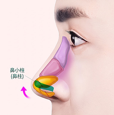 展示男性鼻部整形中在鼻小柱部位植入支撑架以抬高鼻尖原理的侧面内部结构图解