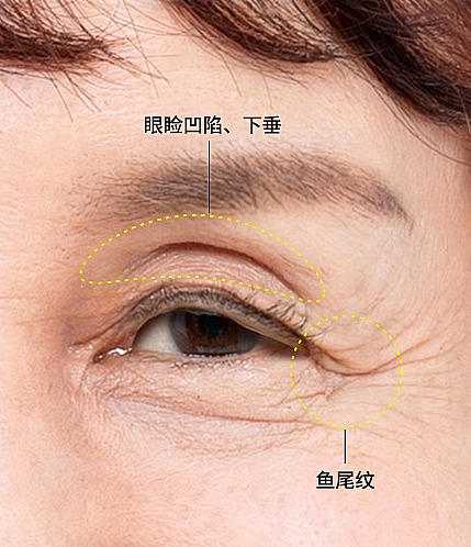 用于眉上提眉及中老年眼部整形诊断用虚线标注眼睑凹陷下垂部位与眼尾皱纹的中老年女性眼部特写