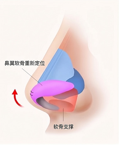 鼻侧面解剖图解，展示长鼻 / 箭形鼻整形时通过鼻翼软骨重排与软骨支架实现鼻尖提升的原理