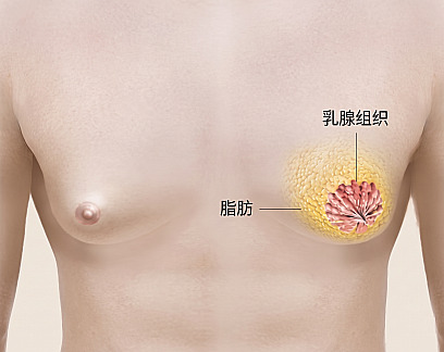 说明男性胸部内部脂肪与乳腺组织位置的男性乳腺发育症结构指南图解