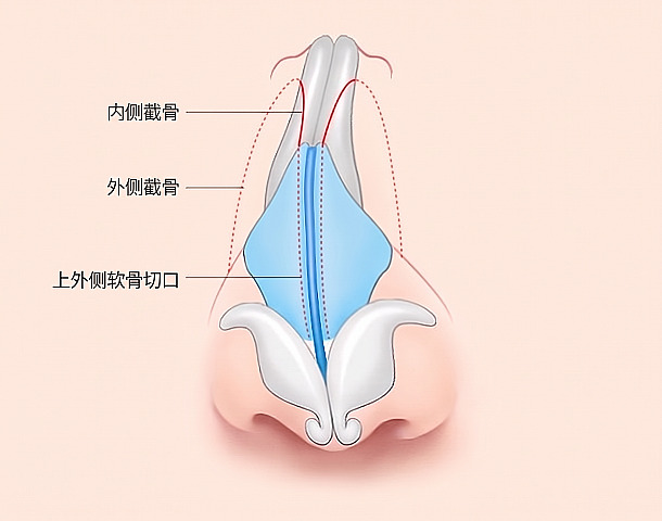 为进行歪鼻整形，在鼻骨和软骨结构上标出内侧截骨、外侧截骨及上外侧鼻软骨切口线的手术方法示意图