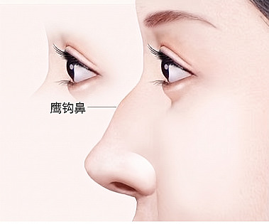 APEX整形外科鼻部整形指南图解，展示鼻梁中部突出的驼峰鼻女性侧颜及标示驼峰部位的指示线