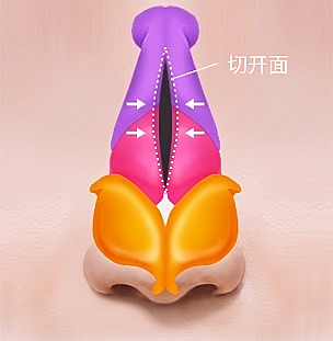 驼峰鼻整形时以截骨面为中心聚拢两侧鼻骨过程的鼻部解剖结构图解
