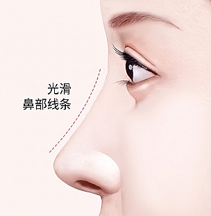 驼峰鼻整形后用虚线标注笔直流畅鼻梁线条的女性侧面插图及光滑鼻线条文案