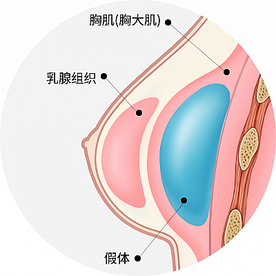 展示隆胸手术中假体植入大胸肌下方结构的乳房解剖截面图解