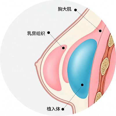 解剖学剖面示意图，展示隆胸手术中假体置于胸大肌和乳腺组织下方的结构