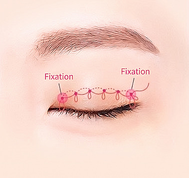 Diagram illustrating non-incisional double eyelid surgery, showing continuous suture knots along the closed eyelid line anchored at both ends