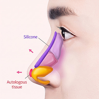 Profile diagram showing the placement of a silicone implant on the nasal bridge and autologous tissue at the nasal tip for men's rhinoplasty