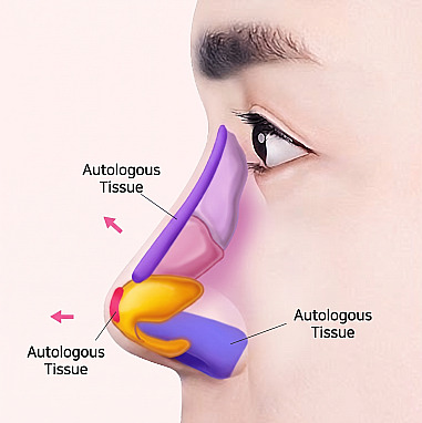 Cross-sectional diagram for Men's Rhinoplasty showing where autologous tissue is applied to internal nasal cartilage, including the bridge and tip