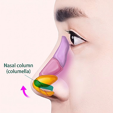 Side-view internal structural diagram showing the principle of inserting a columellar strut to raise the nasal tip in Men's Rhinoplasty