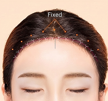 Graphic guide showing the scalp pulled, securely fixed, and micro-sutured along the hairline during Forehead Reduction