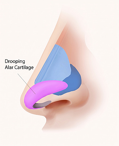 Lateral nasal anatomical diagram showing downward-drooping alar cartilages referenced in Long / Droopy Nose rhinoplasty