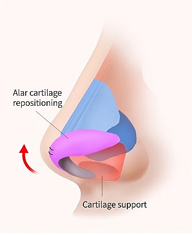 Lateral nasal anatomy diagram illustrating the principle of Nasal Tip lifting via alar cartilage repositioning and cartilage strut for Long / Droopy Nose rhinoplasty