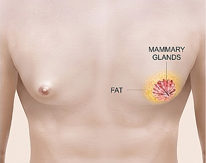 Medical illustration showing the location of glandular tissue and fat to explain the causes of male gynecomastia