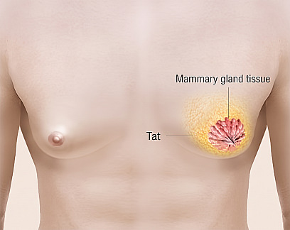 Anatomical diagram illustrating the distribution of fat and glandular tissue inside the male chest for gynecomastia