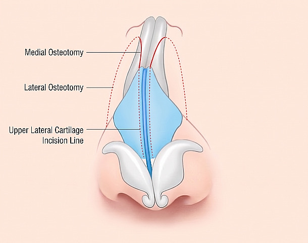 Surgical technique diagram marking medial osteotomy, lateral osteotomy, and upper lateral cartilage incision lines on nasal bone and cartilage for Crooked Nose rhinoplasty