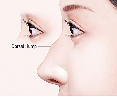 APEX Plastic Surgery Rhinoplasty guide diagram showing the profile of a woman with a protruding mid-dorsum Hump Nose and an indicator line pointing to the hump