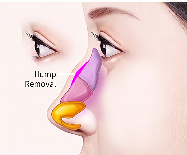 Profile diagram marking the area of hump reduction where protruding bone and cartilage are removed during Hump Nose Rhinoplasty