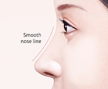Profile of a woman showing a smooth nasal bridge created through Hump Nose Rhinoplasty with the text Smooth Nose Line
