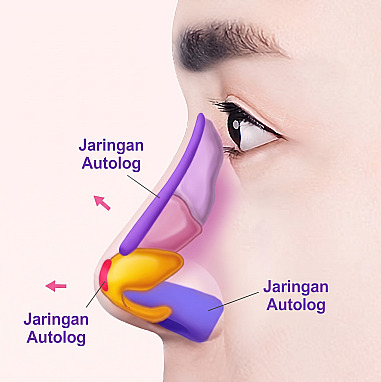 Diagram struktur penampang samping yang menunjukkan area penerapan jaringan autologus pada struktur tulang rawan dalam hidung seperti batang dan ujung hidung pada rinoplasti pria