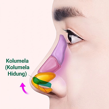 Diagram struktur internal tampak samping yang menunjukkan prinsip peninggian ujung hidung dengan memasang penyangga pada area kolumela dalam rinoplasti pria