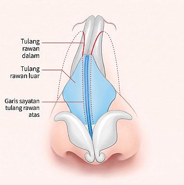 Diagram struktur internal hidung yang menunjukkan area osteotomi medial, osteotomi lateral, dan garis sayatan kartilago lateral atas pada rinoplasti pria