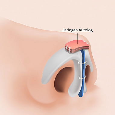 Diagram struktur ujung hidung pada rinoplasti pria yang memperlihatkan jaringan autolog ditempatkan di atas tulang rawan alar dan dijahit bersama penyangga