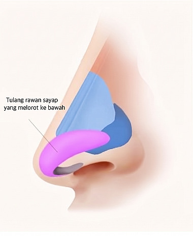 Diagram anatomi hidung tampak samping yang menunjukkan tulang rawan alar yang terkulai ke bawah sebagai referensi operasi hidung panjang dan droopy nose