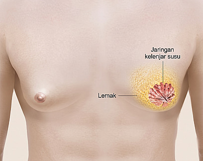 Diagram struktur panduan ginekomastia yang menjelaskan letak jaringan lemak dan kelenjar susu di dalam payudara pria