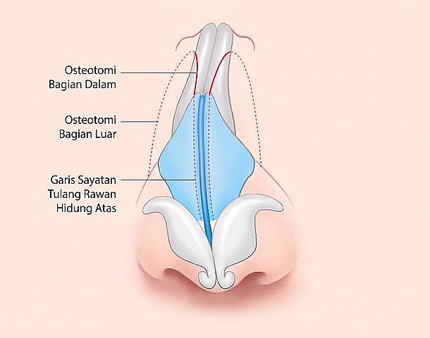 Diagram metode operasi Hidung Bengkok yang menandai garis sayatan osteotomi medial, osteotomi lateral, dan tulang rawan hidung atas pada struktur tulang serta tulang rawan hidung