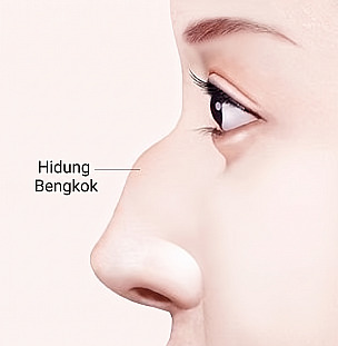 Ilustrasi tampak samping sebelum operasi Hidung Berpunuk dengan bagian tengah batang hidung yang menonjol beserta garis petunjuk punuk