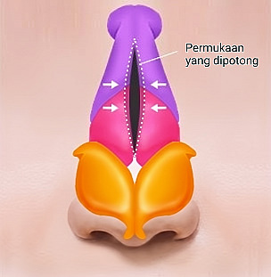 Diagram anatomi hidung yang menunjukkan proses menyatukan kedua sisi tulang hidung di sekitar permukaan yang dipotong pada Operasi Hidung Berpunuk