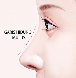 Ilustrasi profil samping wanita dengan garis putus-putus yang menunjukkan garis hidung lurus dan mulus setelah operasi hidung berpunuk beserta teks Garis Hidung Halus