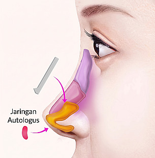 Diagram anatomi tampak samping yang memperlihatkan proses pemasangan implan batang hidung dan jaringan autologus di area ujung hidung pada operasi hidung pendek