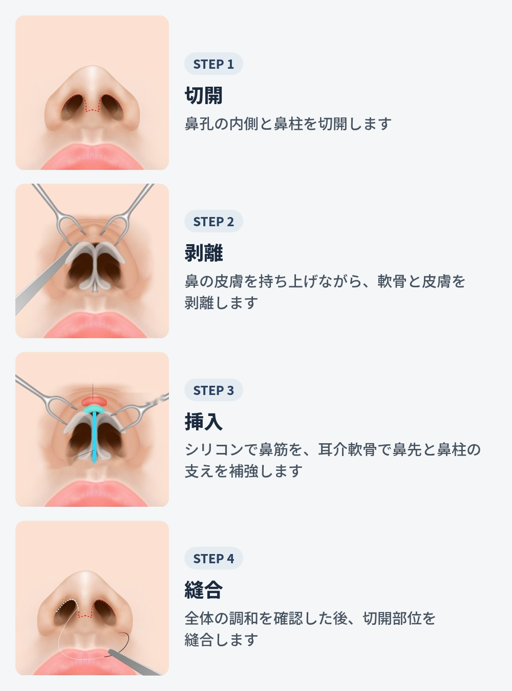 鼻を下から見たイラスト4枚。ステップ1は鼻柱と鼻の穴の内側の切開線、ステップ2は器具で皮膚を持ち上げて鼻先軟骨が露出した様子、ステップ3はシリコンで鼻筋を、耳介軟骨で鼻先と鼻柱の支持部を補強する様子、ステップ4は切開部位を縫合する様子です。