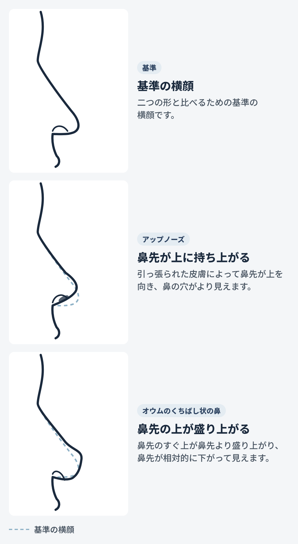 鼻の横顔の線画3枚。1つ目は基準となる横顔、2つ目は薄い点線で描かれた基準よりも鼻先が上を向いて鼻の穴が見えるアップノーズの形、3つ目は鼻先のすぐ上が鼻先よりも突出し、鼻先が相対的に垂れ下がって見えるオウムのくちばし状（ポリービーク変形）の鼻です。