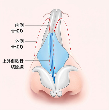メンズ鼻整形で内側骨切り、外側骨切り、上外側鼻軟骨の切開線部位を示した鼻の内部構造図